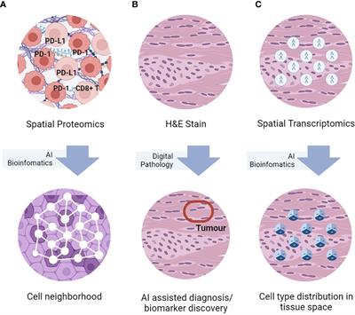 The promise and challenge of spatial omics in dissecting tumour microenvironment and the role of AI